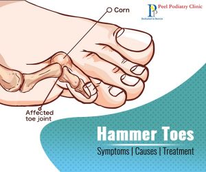 Symptoms, Causes And Treatment Of Hammer Toes | Peel Podiatry Clinic