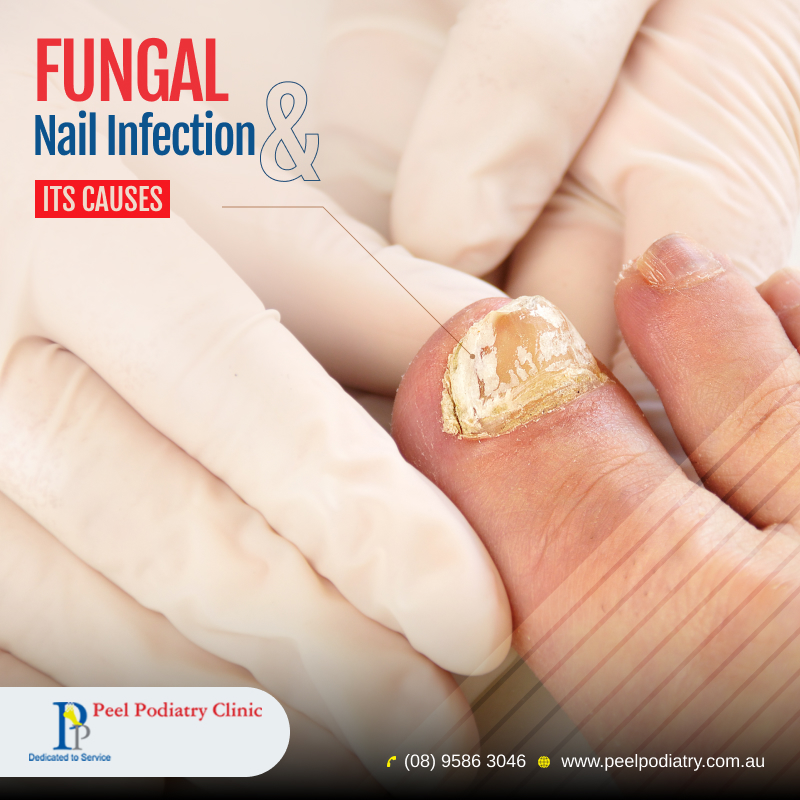 What Are the Causes of a Nail Bed Infection? | Spire Orthopaedic